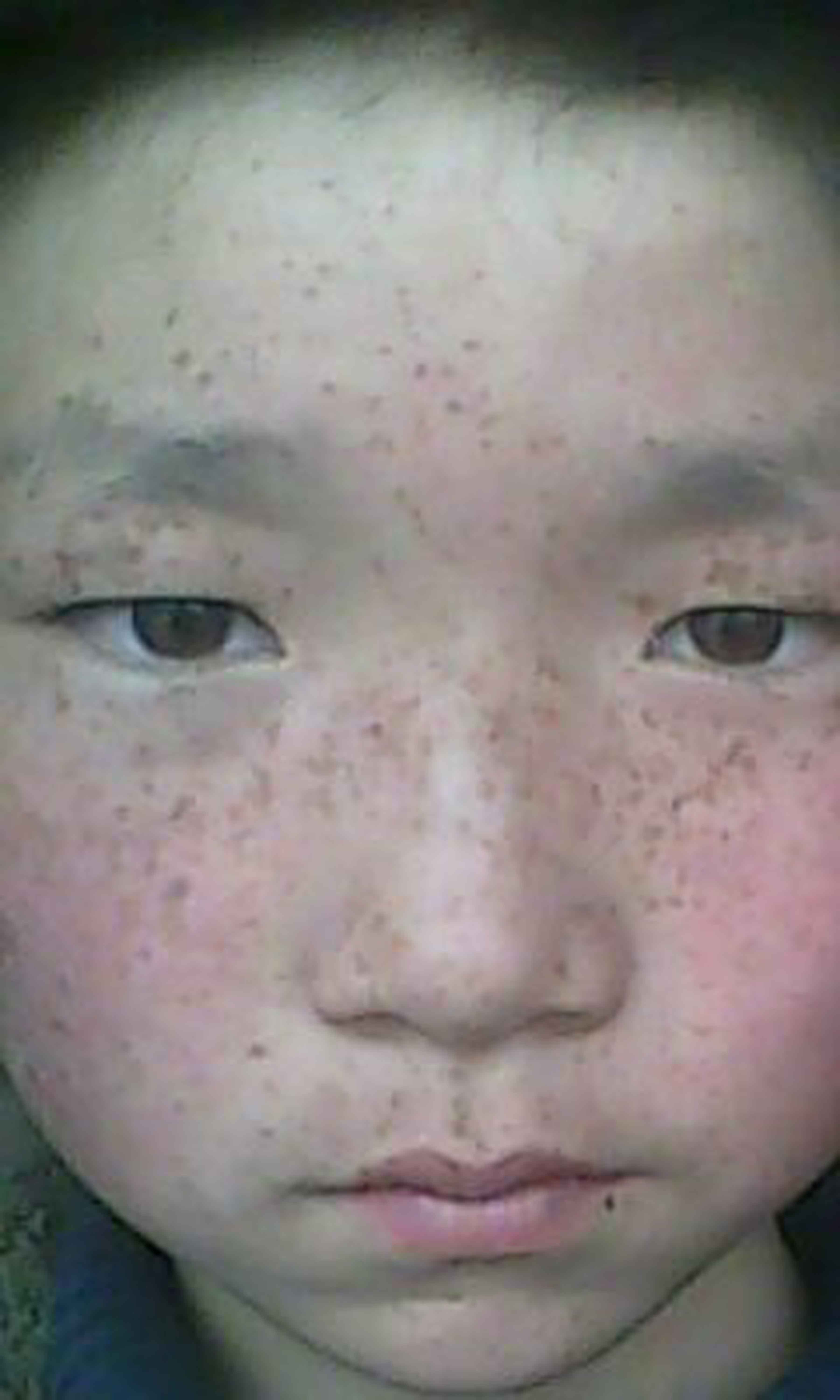 有雀斑的表面 库存照片. 图片 包括有 鼻子, 招标, 眼睛, 睫毛, 有雀斑, 少年, 白种人, 和平, 青少年 - 1713952